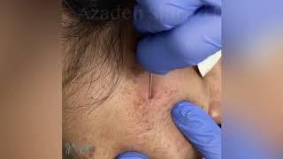 Acne Scar Subcision