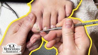 Prevent Ingrown Toenails