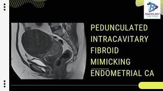 Pedunculated intracavitory fibroid vs Endometrial carcinoma # Umamaheswara Reddy.V