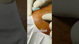 Ganglion Cyst