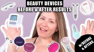 BEAUTY DEVICES BEFORE & AFTERS RESULTS  ORALIFT ZIIP FOREO ADURO MYOLIFT and MEDICUBE