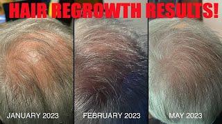 Calecim hair treatment results at six months  With OneSkin update