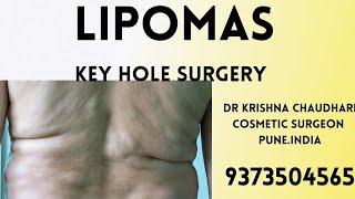 #LIPOMA REMOVAL BEFORE AFTER##LIPOMA REMOVAL COST IN PUNE#