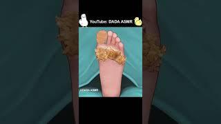 ASMR  Surgery to Remove Large Plantar Warts Animation  Corn Foot Calluse HPV Treatment part1
