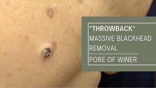 *THROWBACK* Massive Blackhead Removal POW Dr. Derm