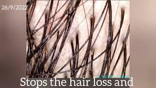 What is hair follicle enrichment? who would benefits from it? www.daneshaesthetics.com