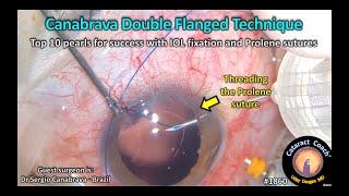 CataractCoach™ 1860 Canabrava double flanged technique for IOL fixation