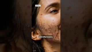 2 Types of Acne  Inflammatory Acne vs Noninflammatory Acne