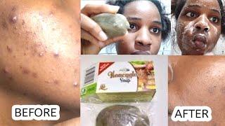 Runo HoneyGlow Soap  My Honest Review  Best for Acnes Pimples Rashes Ezecma??