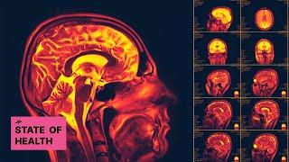 Apixaban for Stroke Prevention in Subclinical Atrial Fibrillation