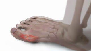 Battling bunions What causes them how they can be managed
