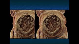 CT of the Small Bowel Complications of Therapy and How They Mimic Pathology - Part 2