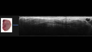 Real-Time Volumetric Analysis of Intraoperative Wide-Field Optical Coherence Tomography Imaging Data