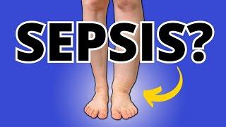 Alert FootAnkle Swelling & Edema Can Cause Serious Sepsis Know This