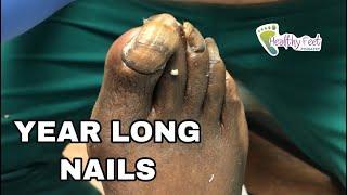 Year Old Long Toenails