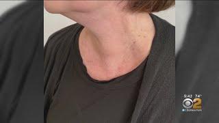 New Treatment For Risky Thyroid Nodules