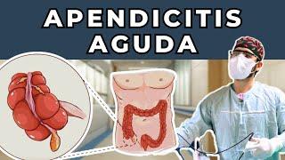 ¡APENDICITIS AGUDA Cirugía de URGENCIA más común - Síntomas Diagnóstico Tratamiento