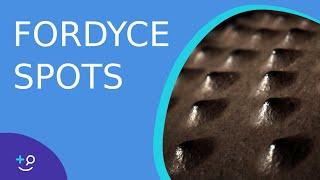 Fordyce Spots Oil Glands or Warts?