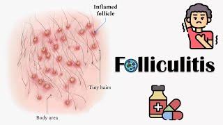 Folliculitis - Causes Signs & Symptoms Complications & Treatment