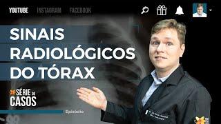 PRINCIPAIS SINAIS RADIOLÓGICOS DO TÓRAX PARTE 1