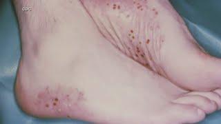 New research could help with future eczema treatment