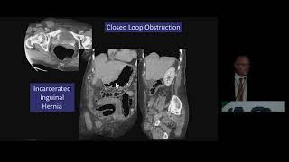 CT Bowel Obstruction What Really Matters?  Free Radiology CME