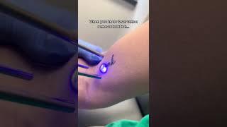 Laser tattoo removal #shorts
