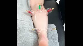 Myofascial Cupping - Calf and Achilles