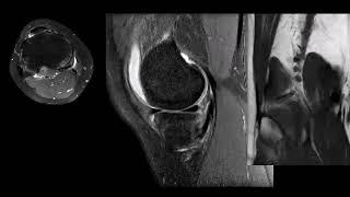 Что покажет МРТ коленного сустава?