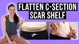 Do This To Your C-Section Scar EVERY DAY To FlattenPrevent C-Section Scar Shelf