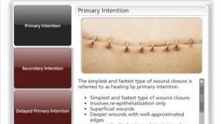 Types of Wound Closure