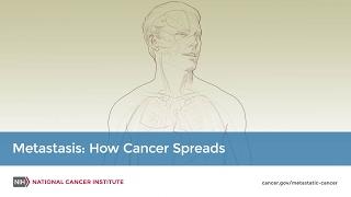 Metastasis How Cancer Spreads