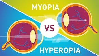 Difference between Myopia Near Sightedness & Hyperopia Far-Sightedness