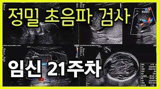 임신 21주 임신중기 정밀초음파 검사 성별 확정🪅