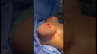 Mammoplasty at Agapit Medical Center