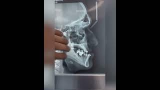 جراحی زیبایی دو فک کیس ارتوسرجری
