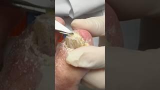 Cutting Thick Crumbly Yellow Nails #shortsvideo #nails #foot #thicktoenails