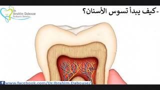 كيف يحدث تسوس الأسنان.    Dental caries how it is occur