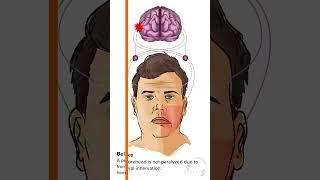 Bell Palsy vs Stroke