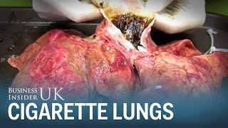 What your lungs look like after just 20 cigarettes