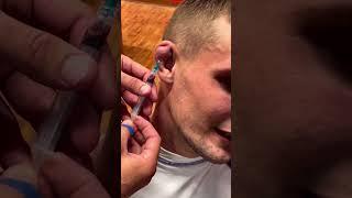 Cauliflower ear draining Pt. 2  