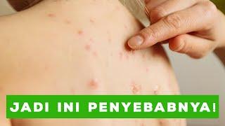 Hati-hati Terkena Herpes  Kenali Penyakit Kulit Yang Disebabkan Oleh Virus 