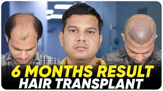 Hair Transplant in Turkey  Best Results & Cost of Hair Transplant in Turkey