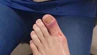 Treating Inflammation and Infection of the Proximal Nail Fold