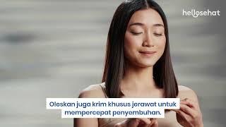 Cara Menghilangkan Jerawat Batu yang Ampuh dan Efektif