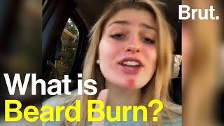 What is Beard Burn?