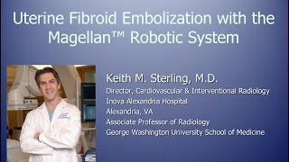 Robot Assisted Uterine Fibroid Embolization UFE with Magellan