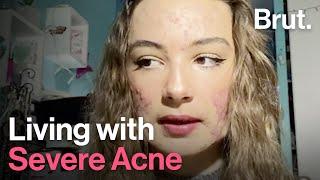 Living with Severe Acne Mattéa Tells Her Story