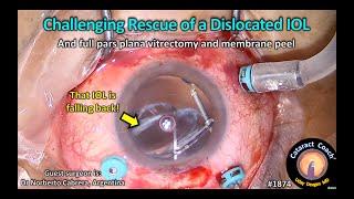 CataractCoach™ 1874 challenging rescue of a dislocated IOL