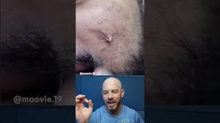 GIANT cyst pop #cystpop #cyst #dermreacts #doctorreacts